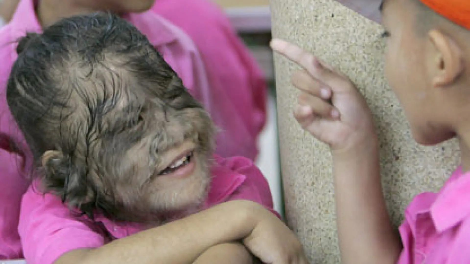Qué ha sido de Supatra 'Natty' Sasuphan, la niña "más peluda del mundo"