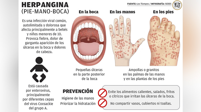 Sedes reporta un brote de herpangina, una enfermedad altamente contagiosa