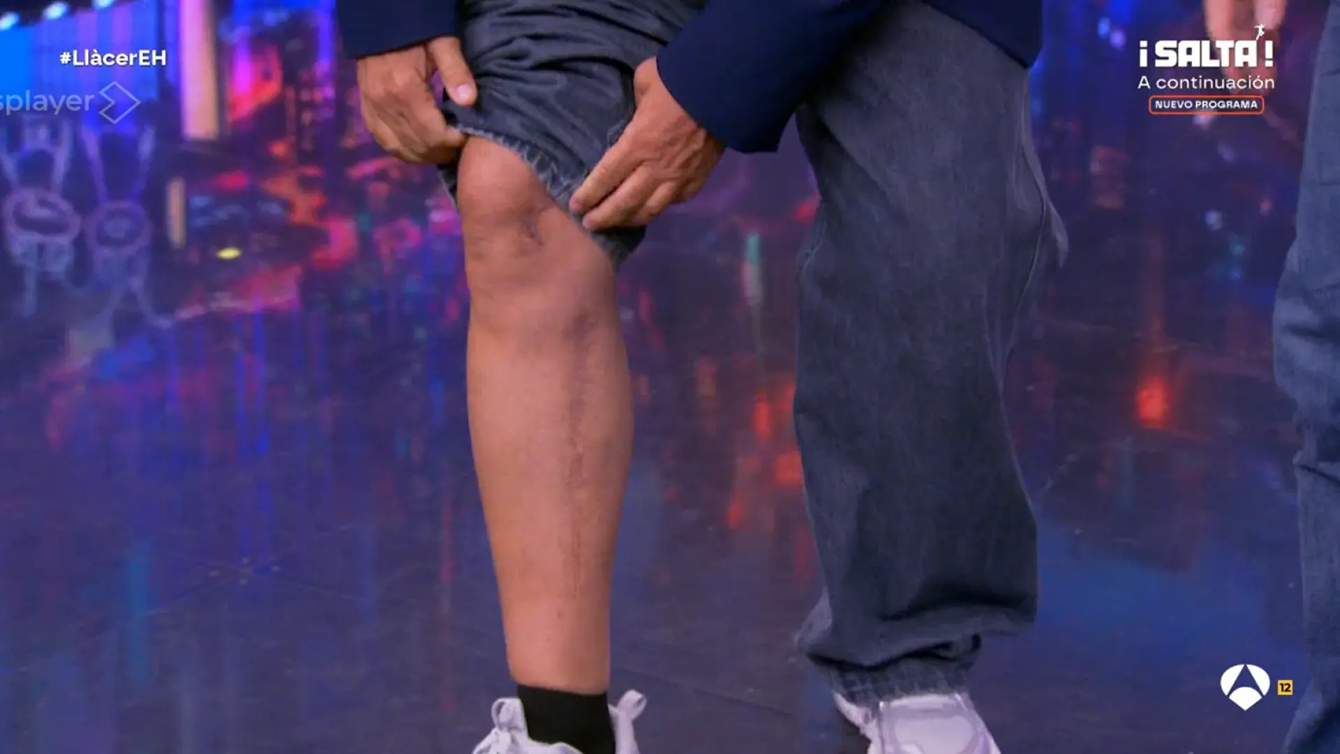 Àngel Llàcer muestra las secuelas de la bacteria en 'El Hormiguero': "Tengo la pierna de un torero"