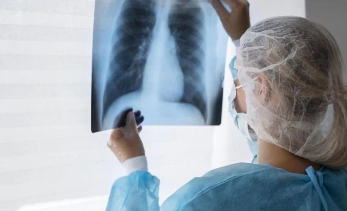 Récord de tuberculosis en el país: subieron 71,6% los casos en seis años