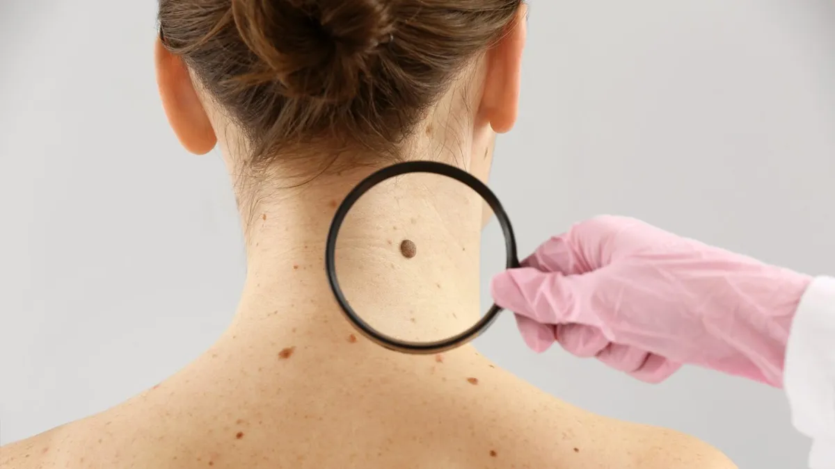 OSEP realizará una serie de actividades por el Día Mundial del Cáncer de Piel