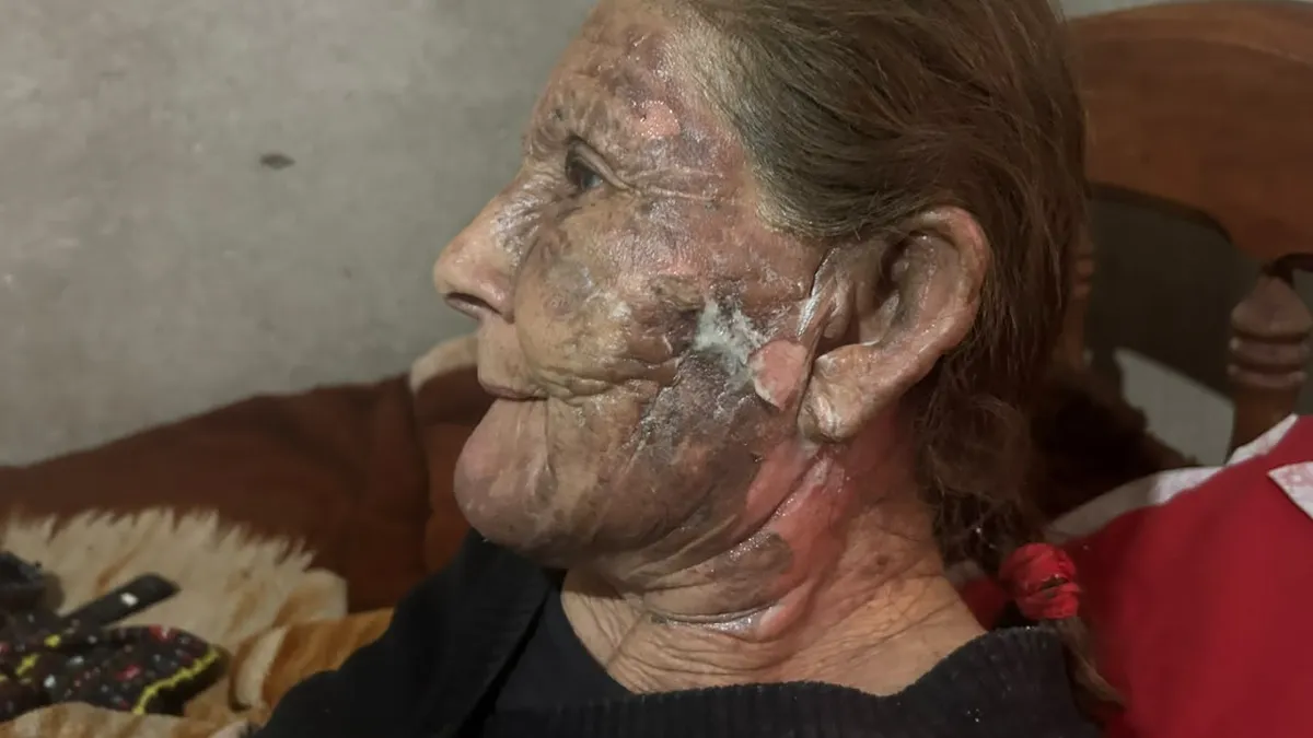 Quemó a su expareja y lo imputaron por intento de homicidio agravado