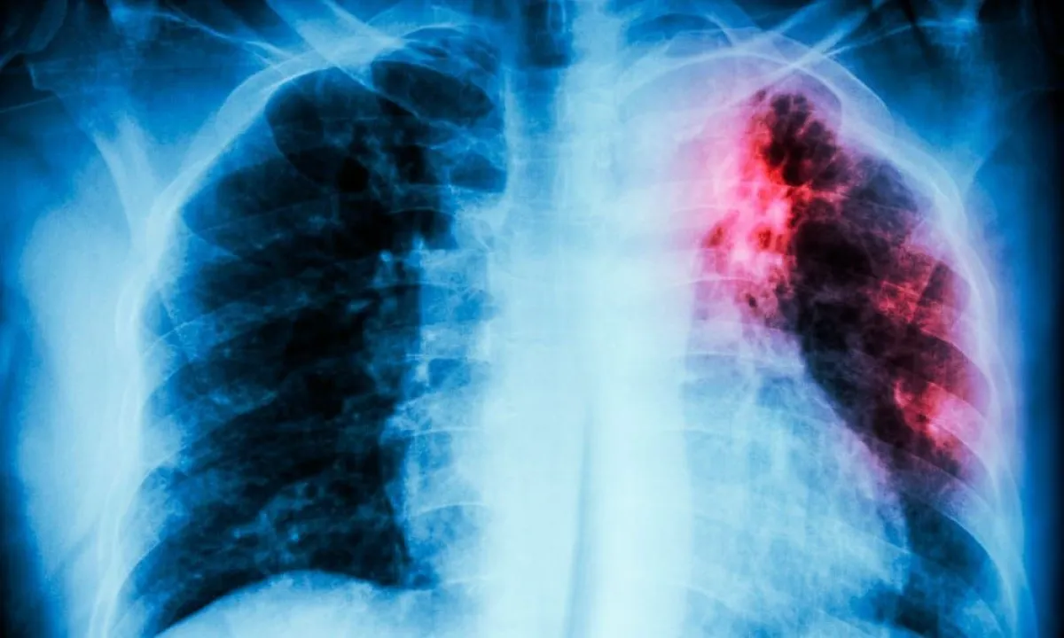 Misiones registró el mayor aumento porcentual del país en casos de tuberculosis