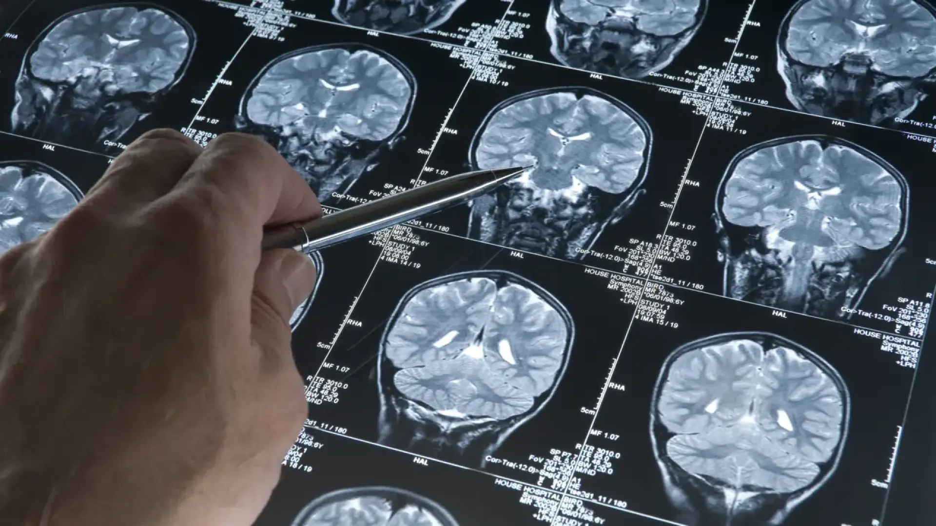 Un ensayo clínico "sin precedentes" muestra que una vacuna contra el cáncer puede erradicar tumores completos en pacientes