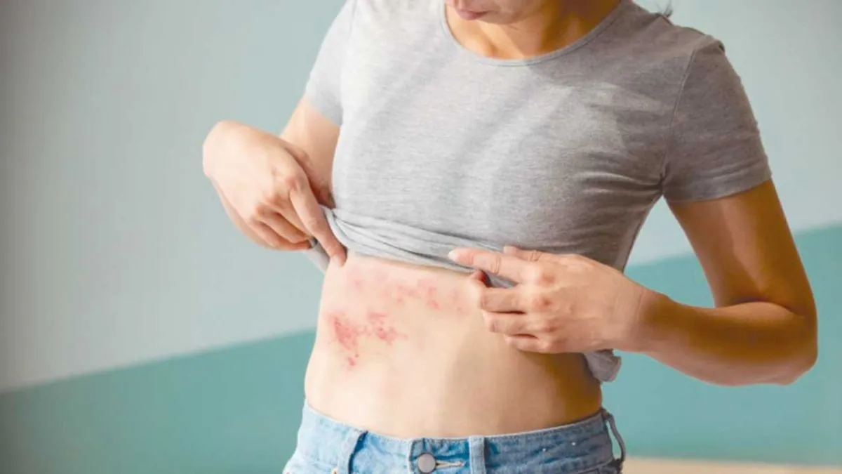 Zóster, el virus de la varicela que puede reactivarse por estrés