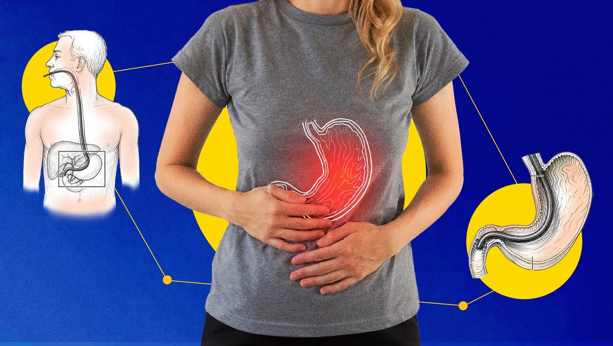 Inflamación del estómago: causas y señales de alarma