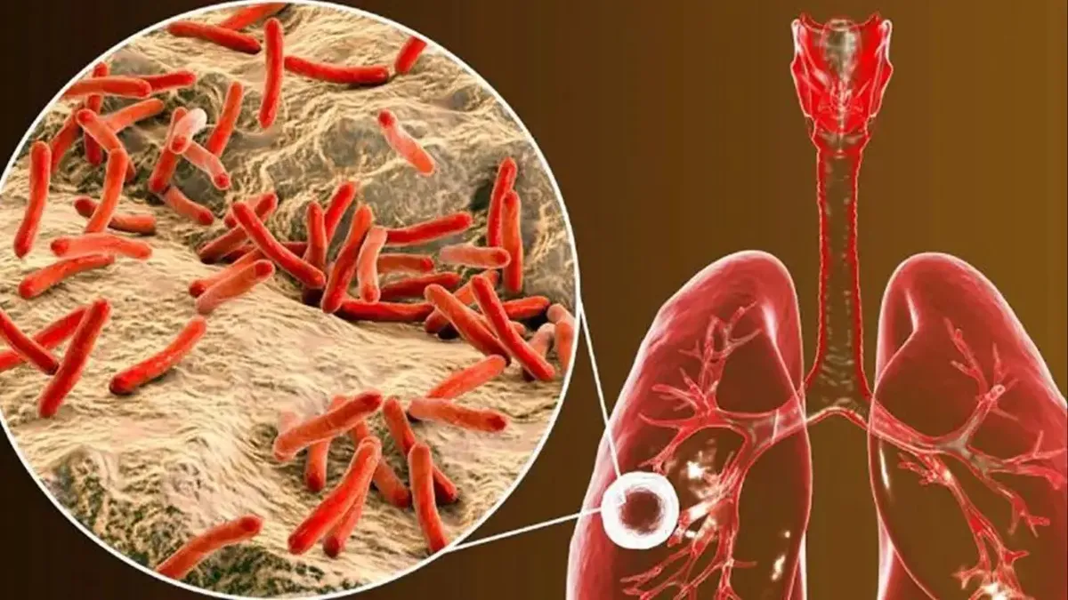 Crecen los casos de tuberculosis en Argentina y advierten por un récord de contagios