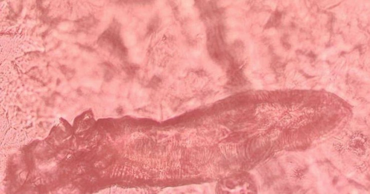 Investigan con pacientes de Corrientes y Chaco si la psoriasis altera un ácaro de la piel